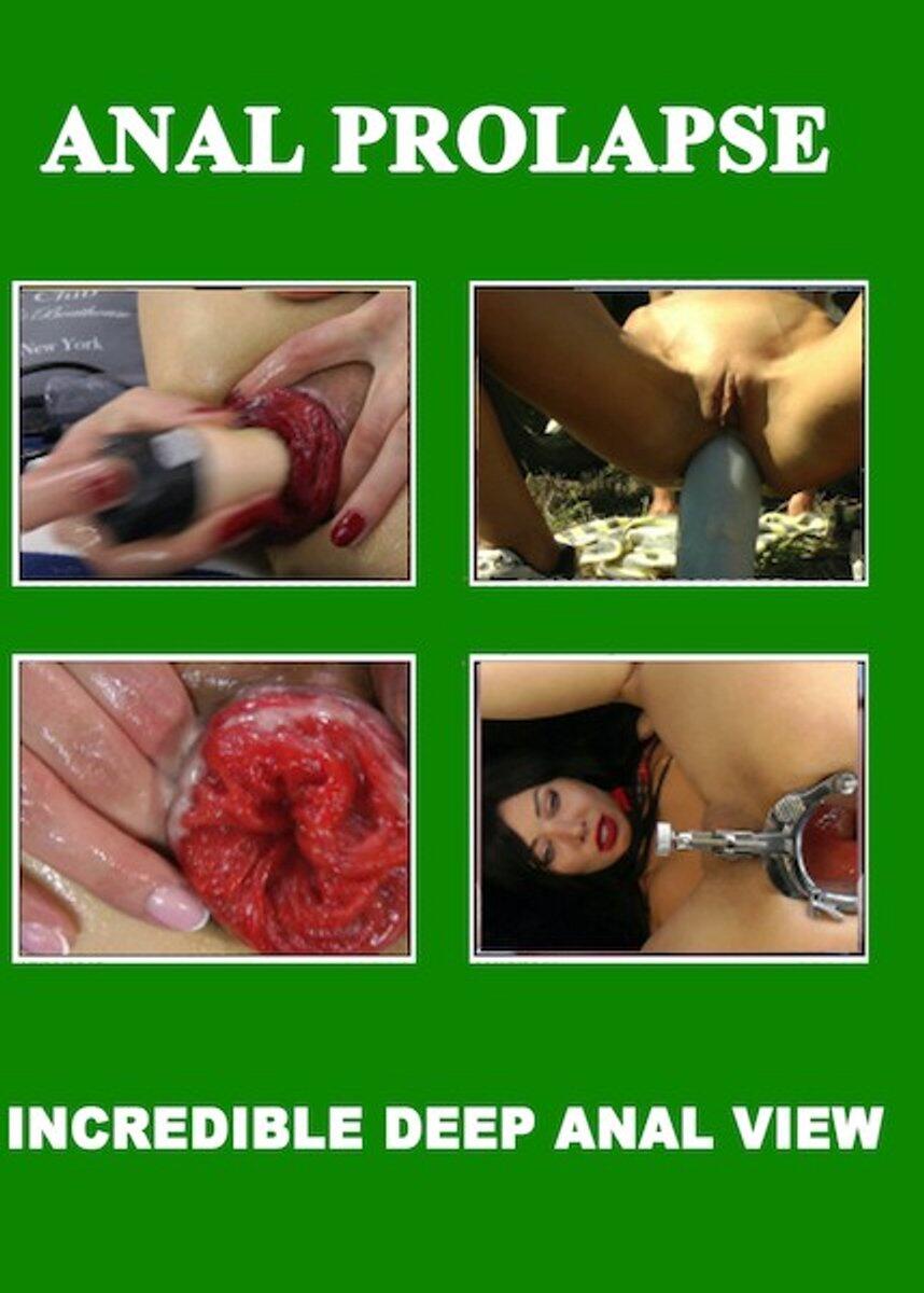 Anal Prolapse Incredible Deep Anal View