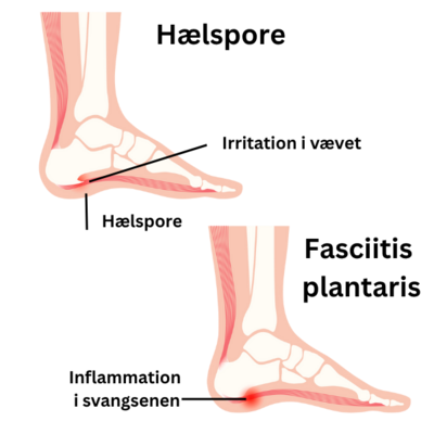 hælspore vs fasciitis plantaris