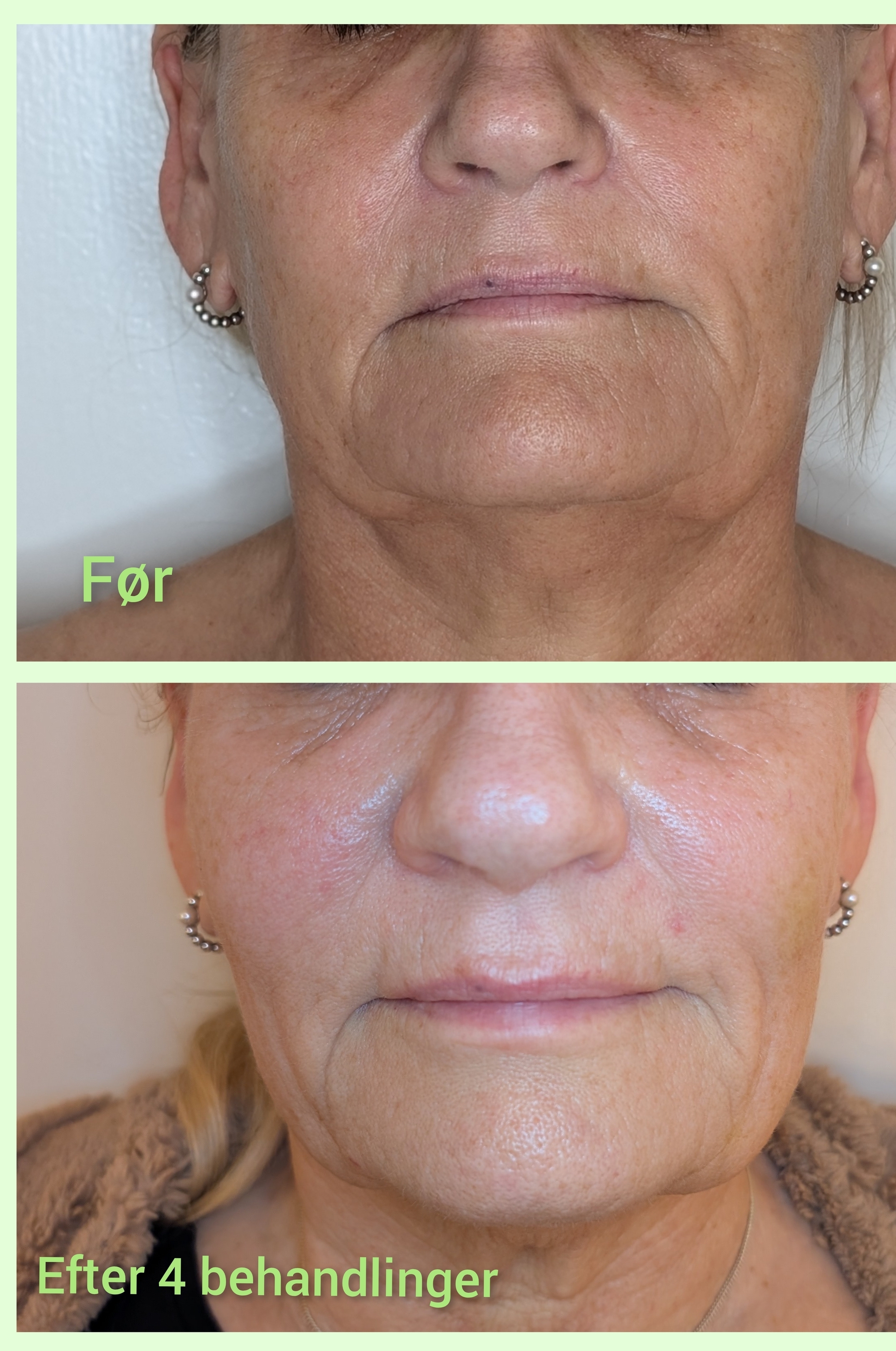 AcuBeauty-behandling-for-nedadvendte-mundvige