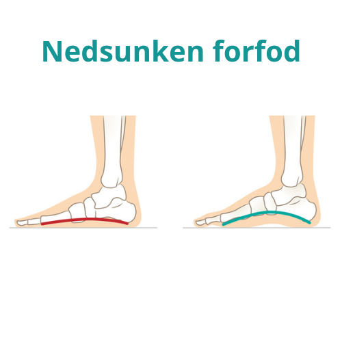 Nedsunken forfod