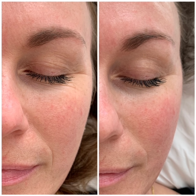 Løft-af-tunge-øjenlåg-og-linjer-omkring-øjne