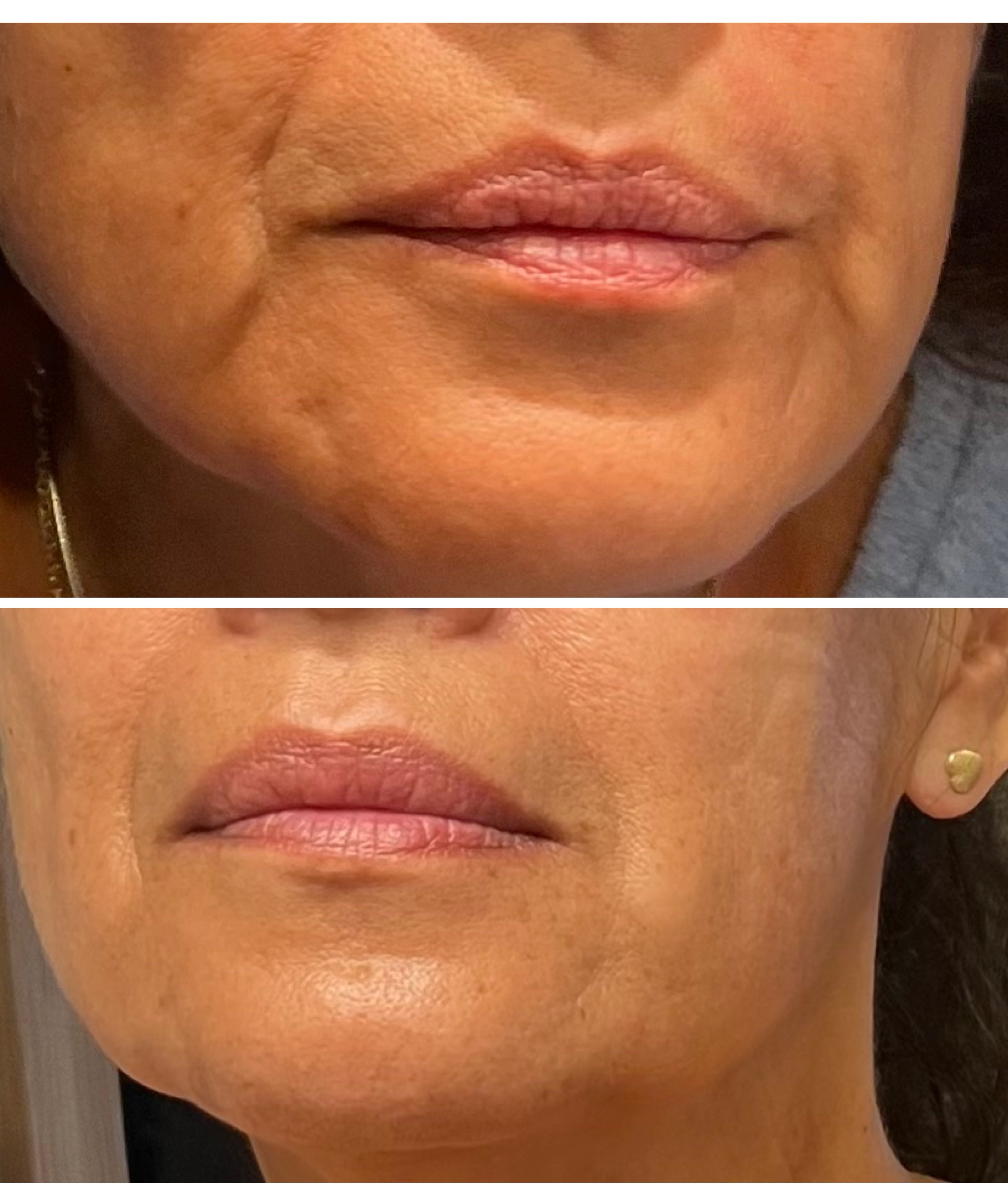 kæbespændinger-og-posede-kinder